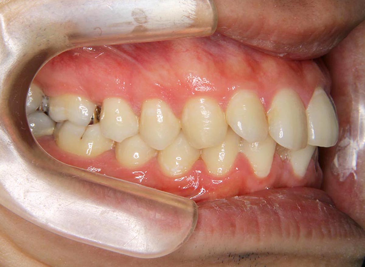 上顎前突 出っ歯 症例の症例一覧 最新の治療例 アップル歯列矯正歯科 自由が丘