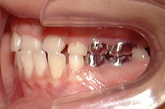 埋伏歯（埋まっている歯を出す）治療前